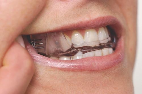 Sleep Apnoea Treatment in North Brisbane Dental Clinic