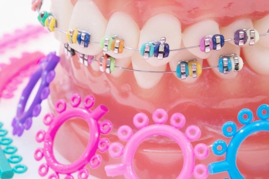 Traditional Braces in Wooloowin, QLD