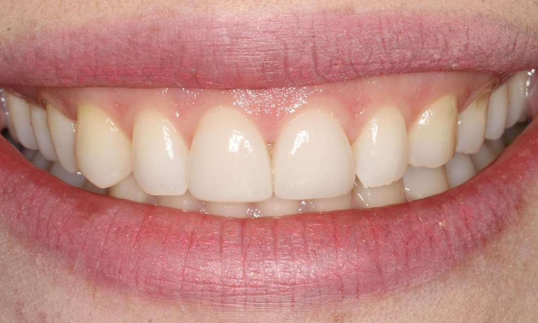 Porcelain Veneers After | North Brisbane Dental Clinic