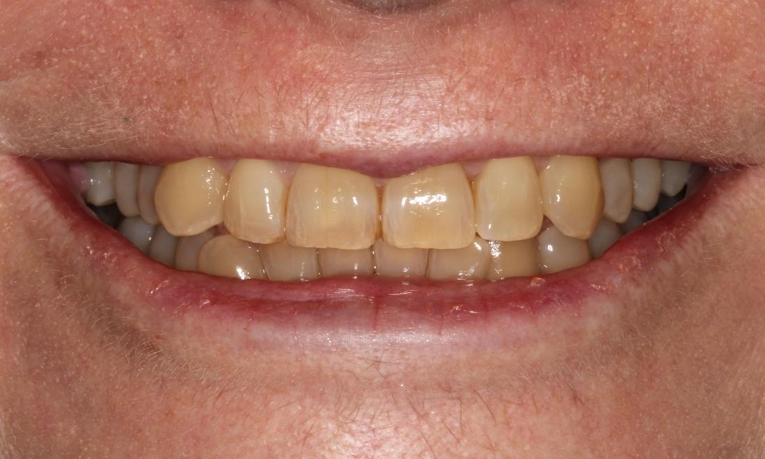 Zoom Whitening Before & After Photos Wooloowin Queensland Zoom Whitening Before & After Photos Wooloowin Queensland