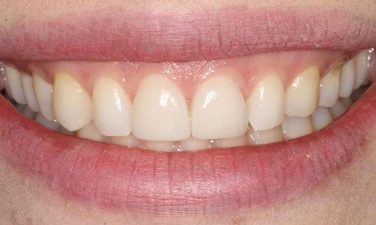 Porcelain Veneers After | North Brisbane Dental Clinic