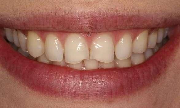 Porcelain Veneers Before | North Brisbane Dental Clinic